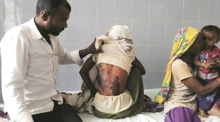 Delhi: Student sits on acid-soaked chair, sustains burns