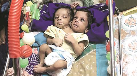 Mumbai Conjoined Twins Surprise Doctors Their Parents Say Cant Let