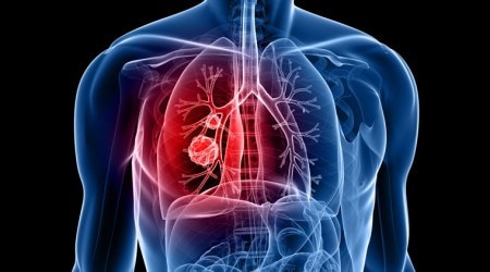 Lung cancer ups suicide risk in men
