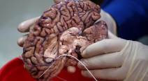 Human brains, Brains, brains in the bronx, New York, Brain hospital, New York brain hospital, brain photos
