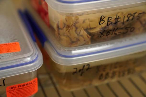 Human brains, Brains, brains in the bronx, New York, Brain hospital, New York brain hospital, brain photos
