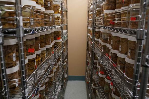Human brains, Brains, brains in the bronx, New York, Brain hospital, New York brain hospital, brain photos