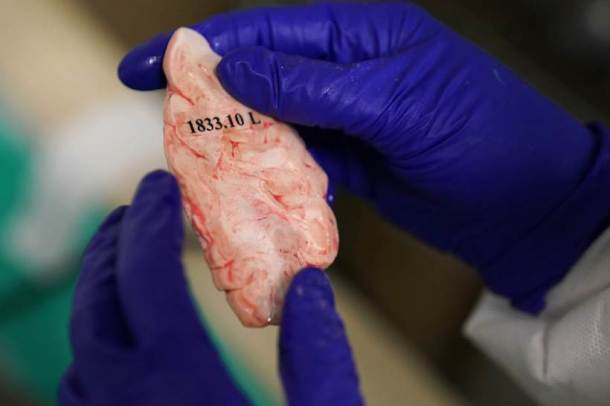 Human brains, Brains, brains in the bronx, New York, Brain hospital, New York brain hospital, brain photos