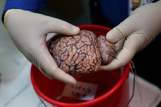 Human brains, Brains, brains in the bronx, New York, Brain hospital, New York brain hospital, brain photos