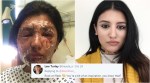 Brave acid attack survivor shares selfie on social media as inspiration for others