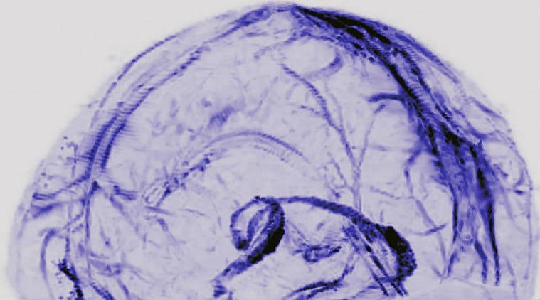 Brain, lymphatic system, US National Institutes of Health study, National Institutes of Neurological Disorders and Strokes, blood vessels, lymphatic vessels, brain immune-system relation, brain scans, autopsy studies 
