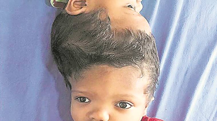 conjoined twins, aiims conjoined twins surgery, aiims surgery, conjoined twins separation, delhi news, indian express news