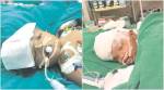 Odisha conjoined twins: Taken off ventilator support, one baby starts recognising mother