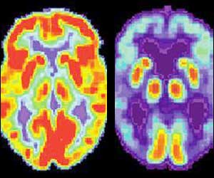 Research reveals some of Alzheimer’s secrets | Health News - The Indian ...