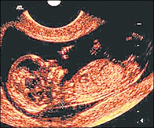 abortion, abortion laws, India abortion laws, India, Maharashtra abortion laws, Maharashtra news, India news, latest news, world news, international news, Colin Gonsalves, Medical Termination of Pregnancy Act