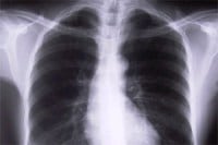 Lung tests, mobile lung testing, Delhi government, MAMC, mobile health checkup, delhi news