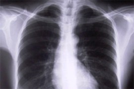 Lung tests, mobile lung testing, Delhi government, MAMC, mobile health checkup, delhi news