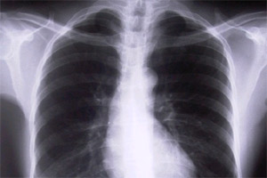 Lung tests, mobile lung testing, Delhi government, MAMC, mobile health checkup, delhi news