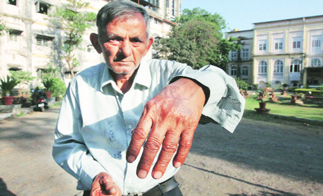 Cops pin hopes on CCTV footage to arrest acid attack accused | Mumbai ...
