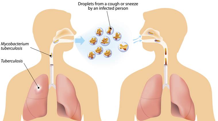 Drug Resistant Tb Cases May Spike In India By 40 India News The Indian Express