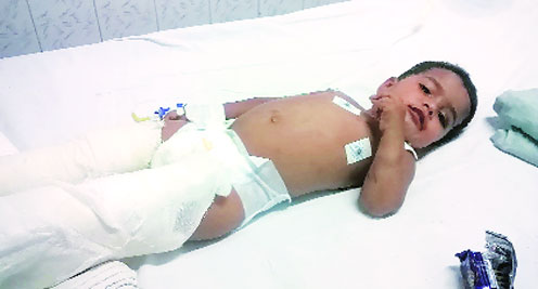 Nearly Rs 50 lakh will be required to ensure continuous medical attention for Samruddhi: Doctors ( Source: Express )