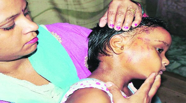 Mother shows the bruises on the face of Ananya in Ludhiana on Sunday. ( Source: Express photo by Gurmeet Singh )
