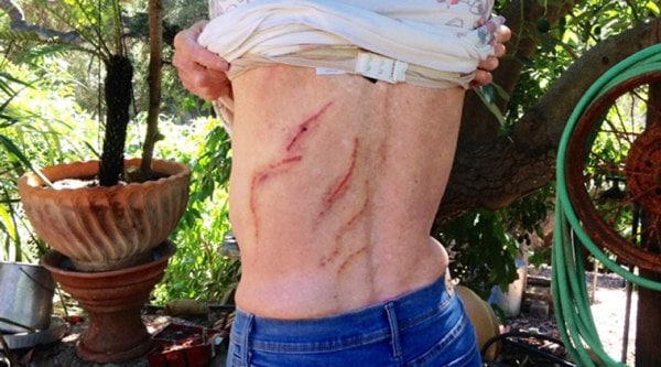 In this Wednesday, Sept. 24, 2014 still image taken from video provided by KEYT-TV, Carpinteria Valley rancher Emily Miles shows scars she received after she was injured when she was attcked by a 300-pound black bear Monday, Sept. 22, in what is called an "unprovoked" attack near Carpinteria, Calif. (Source: AP)