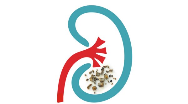 kidney-stone-main