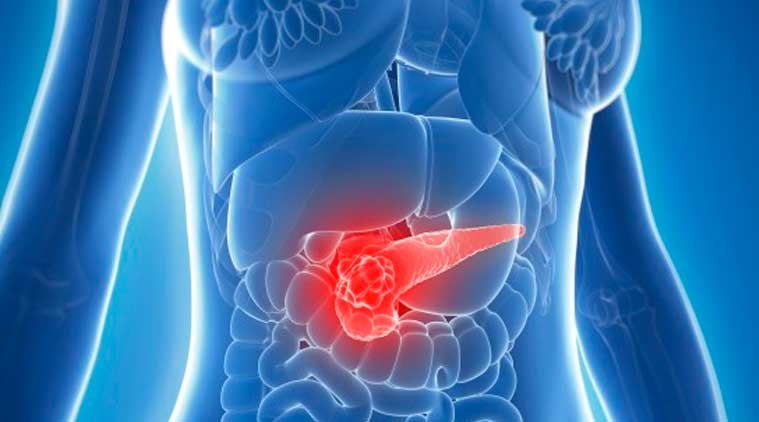 pancreatic-cancer-main