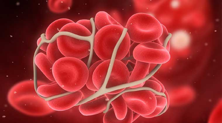 blood clot, cancer, cancer and thrombosis connection, cancer and thrombosis relationship, how cancer happens, how cancer develops, The Indian Express, Indian Express news