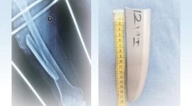 knife in thigh, faulty surgery, faulty operation, chandigarh news, india news