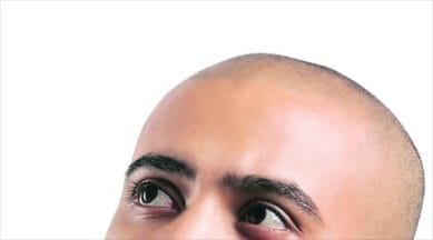 Why are men, in their early 30s, losing hair? | Lifestyle News,The Indian  Express