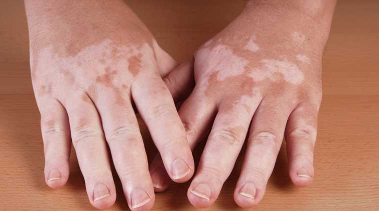 The skin discolouration can be very disturbing and one might lose interest in stepping out with even one spot. 