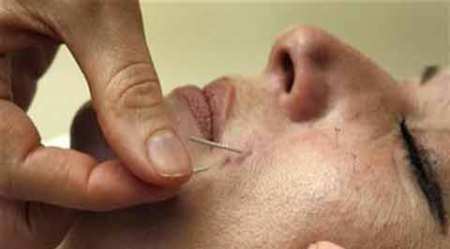 acupuncture, acupuncture maharashtra, acupuncture regulations, maharashtra assembly, maharashtra news, india news, indian express