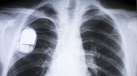 Soon, battery-free pacemakers powered by your heart | Health News - The ...