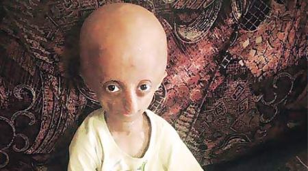 progeria, progeria kid, kid fighting progeria, nihal bitla, mumbai news