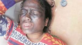 soni sori, soni sori attack, soni sori acid attcak, AAP soni sori, soni sori delhi, soni sori hospital, chhattisgarh soni sori attack, soni sori chhattisgarh, india news, latest news