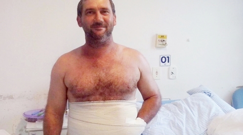 Surgeons try to save man's hand by sewing it into his belly after