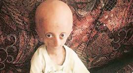 Nihal Bitla, progeria, disease, progeria campaign in India, progeria campaign, Nihal Bitla, mumbai news, india news