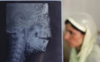 kashmir, kashmir unrest, pellet, pellet guns, doctors protest kashmir, doctors protest srinagar, pellet guns victims, pellet injuries