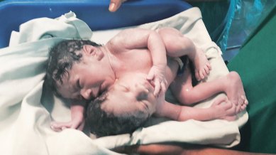 twins, conjoined twins, conjoined twins separation, conjoined twins separate brains, Sion hospital, Mumbai Sion hospital, mumbai news, health news, india news
