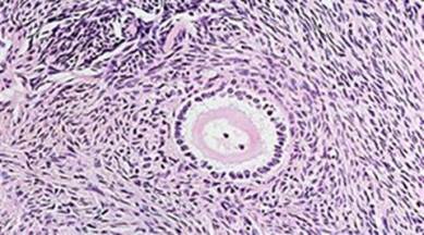 ovarian failure, ovarian problems in women, women fertility, ivf ovarian failure, ovarian problems, health news