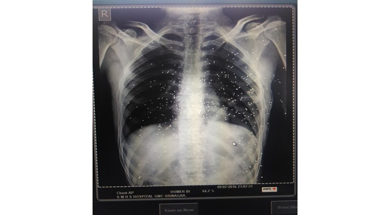 kashmir, kashmir news, CRPF, pellet guns, kashmir deaths, burhan wani, hizbul mujahideen, kashmir protest, kashmir unrest, india news