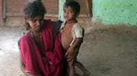 Malnutrition in India, child health, Children with stunted growth, malnutrition in indian children, malnutrition in India 10-most populous cities, Child health study, India news, indian express news