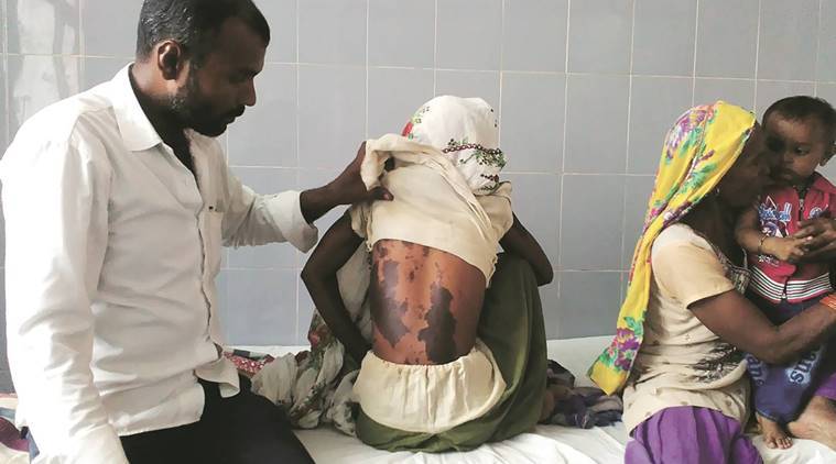 In the burns ward of district hospital in Bulandshahr. (Source: Express photo)