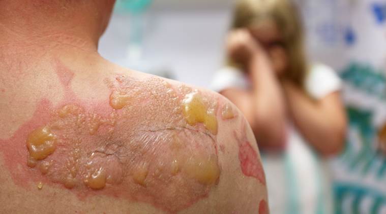 burned skin, burn skin victim, burn skin news cure, latest news, latest health news