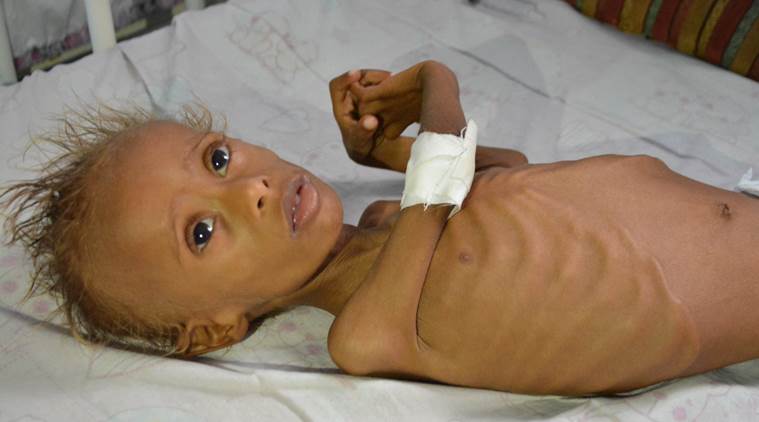 Conflict Ridden Yemen Coast Faces Rising Malnutrition World News The Indian Express