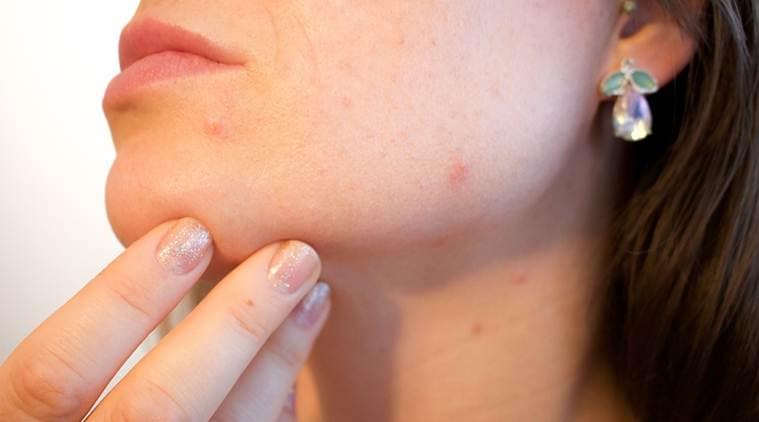 acne, pimples reason behind acne, precaution from acne, oily skin, wrinkles, indian express, indian express news