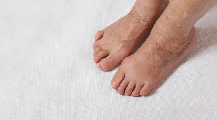 Claw Toes Sign Of Underlying Diabetes Says Doctors Lifestyle News
