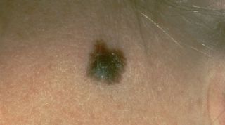 Skin cancer, New drug for skin cancer, Skin cancer cells, melanoma cells, skin cancer drug, new vaccine for skin cancer, how to fight skin cancer, new drugs for skin cancer, how to treat skin cancer, skin cancer treatment, latest drug for skin cancer, science, science news