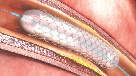 Monitor stent quality under CGHS: Pricing regulator to government ...