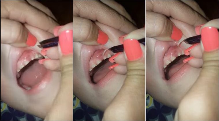 WATCH: In shocking video, mom pulls out 27 fingernails from her son's gums | Trending News,The Indian Express WATCH: In shocking video, mom pulls out 27 fingernails from her son's gums | Trending News,The Indian Express