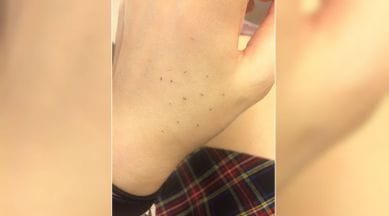 skin treatment, blackhead removal, ocm blackhead removal, how to remove blackheads, indian express, indian express news