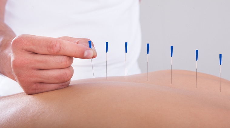 acupuncture, pain-killers, alternatives for pain-killer, Indian express,Indian express news