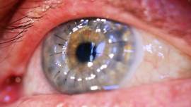 corneal transplant, punjab, punjab news, indian express, punjub health